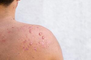 occipitale acne nel un' adolescenziale ragazzo guarito, cicatrici a partire dal adolescenziale acne su il le spalle, pelle infezioni e allergie per il corpo di un' uomo, assistenza sanitaria e medico concetto foto