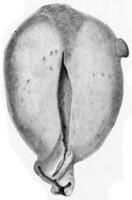 sezione di il utero mostrando uniforme miomato allargamento, Vintage ▾ incisione. foto