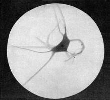 nervo cellula con moderatamente grande crescite, Vintage ▾ incisione. foto