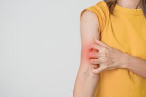 donna pizzicore e graffiare prurito braccio. sensibile pelle allergico reazione per insetto mordere, cibo, droga dermatite. dermatologia, lebbra giorno, sistemico lupus eritematoso, allergia sintomi e eruzione cutanea eczema foto