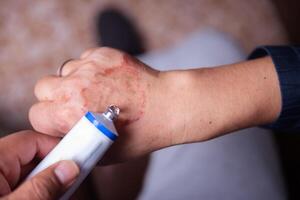 curare con un allergico reazione crema su il mano. foto