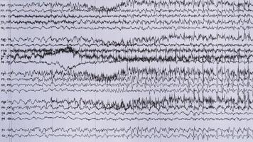 l'imaging di ictale eeg registrazione nel epilessia paziente foto