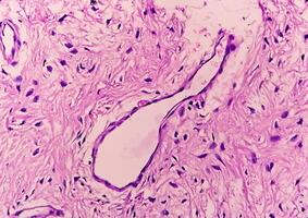 gamba fazzoletto di carta biopsia, fotomicrografico Immagine mostrando fibromixoma. superficiale acrale fibromixoma, raro lento in crescita mixoide tumore foto