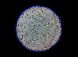 microfotografia di analisi delle urine mostrando abbondanza pus cellule, urinario tratto infezione. foto