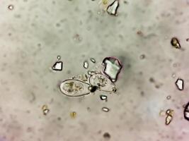 schistosoma parassita ovuli nel umano urina campione sotto microscopio. urinario parassita foto