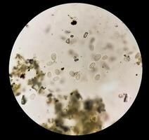 schistosoma parassita ovuli nel umano urina campione sotto microscopio. urinario parassita foto
