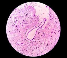 gamba fazzoletto di carta biopsia. fotomicrografico Immagine mostrando fibromixoma. superficiale acrale fibromixoma, raro lento in crescita mixoide tumore. foto