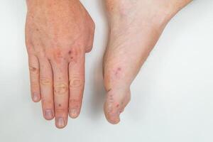 allergico eruzione cutanea su il mano e gamba di un adulto uomo. doloroso eruzione cutanea, rosso vesciche su un' dell'uomo braccio e gamba. umano mano e gamba con dermatite, allergia eruzione cutanea. enterovirus. coxsackie virus foto