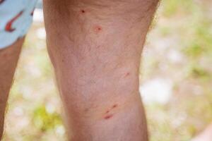 il gamba nel rosso puntini insetto morsi, arrossamento di il pelle dopo moscerini, zanzara mordere irritazione, individuare pruriti. foto