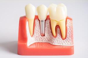 dentale impiantare, artificiale dente radici in mascella, radice canale di dentale trattamento, gomma patologia, denti modello per dentista studiando di odontoiatria. foto