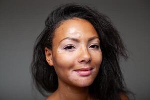 contento nero donna con vitiligine pigmentazione pelle problema foto