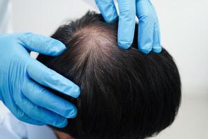 medico toccare grassetto testa nel uomo, capelli perdita trattamento Salute problema. foto