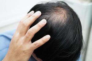 medico toccare grassetto testa nel uomo, capelli perdita trattamento Salute problema. foto