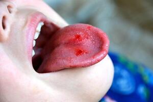 avvicinamento di labbra, lingua, sporgenza di sangue. del bambino Bitten lingua. foto