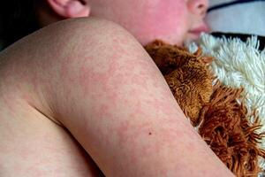 virale patologia. morbillo eruzione cutanea su il corpo di il bambino. allergia foto