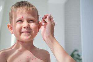 trattamento di ulcere a partire dal varicella, varicella con un' guarigione crema su il pelle di un' bambino. mamma ossequi il del bambino viso con rosso medicinale. foto