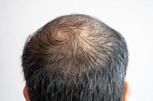 indietro Visualizza di Uomini testa con magro capelli e grigio capelli in crescita. concettuale di capelli problema su Uomini testa. foto
