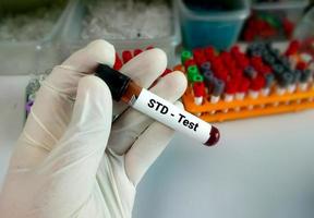 campione di sangue per test std, diagnosi di malattie sessualmente trasmissibili concetto medico e sanitario. foto