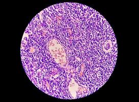 consapevolezza del cancro al seno - immagine microscopica della biopsia del nucleo per carcinoma duttale infiltrante, rilevata mediante mammografia di screening. carcinoma duttale invasivo, grado II foto