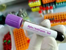lo scienziato tiene la provetta del campione di sangue per il test dell'antitripsina alfa 1 deficit di alfa-1 antitripsina, copd.. foto