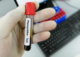 provetta per campioni di sangue per il test della fenciclidina con farmaci dopanti. per determinare la presenza di droghe illegali fenciclidina nel sangue per la pratica giudiziaria o medica.