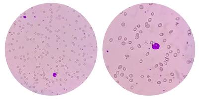 college of due microfotografia che mostra l'anemia leuco-eritroblastica. foto