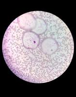 vista microscopica del vetrino colorato di ematologia in laboratorio. avvicinamento. emocromo totale. foto