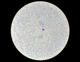 vista micrografica di vetrino ematologico anormale. 10x foto