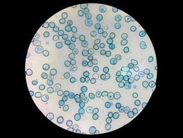 vista microscopica ravvicinata del conteggio anomalo dei reticolociti nel reparto di ematologia, colorazione con blu di metilene foto