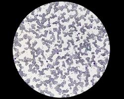 vista microscopica della malattia da agglutinine fredde. anemia emolitica autoimmune. cad foto