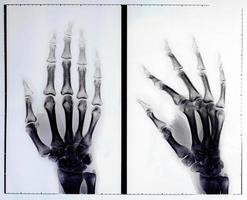 radiografia della mano foto