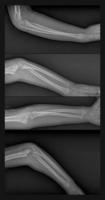 radiografia del braccio rotto foto