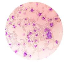 leucemia mielocitica cronica con fase cronica. ematologia. cm foto