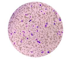 microfotografia di leucemia plasmacellulare o macroglobulinemia di waldenstrom, un raro tipo di cancro dei globuli bianchi foto