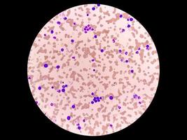 immagine al microscopio di leucemia plasmacellulare o macroglobulinemia di waldenstrom. foto