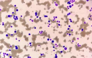 microfotografia di leucemia plasmacellulare o macroglobulinemia di waldenstrom, un raro tipo di cancro che inizia nei globuli bianchi foto