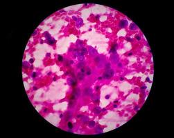 microfotografia di adenocarcinoma metastatico del polmone foto