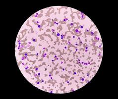 microfotografia di leucemia plasmacellulare o macroglobulinemia di waldenstrom, un raro tipo di cancro dei globuli bianchi foto