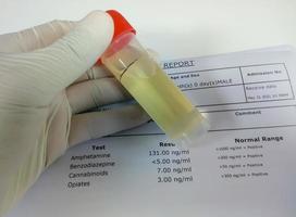 lo scienziato tiene un campione di urina per il test antidroga. test antidroga è l'analisi tecnica di un campione per determinare l'abuso di droghe illegali come benzodiazepine, cannabis, anfetamine, oppiacei. foto