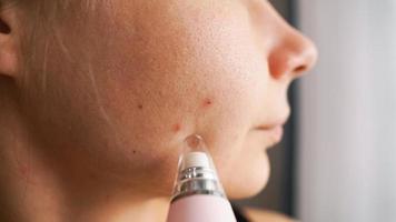 dispositivo di aspirazione per rimuovere punti neri e acne dal viso foto