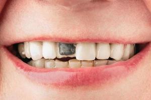 dente anteriore in metallo-ceramica rotto nella bocca femminile foto