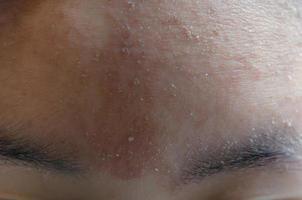 donna con sintomo di dermatite atopica sulla fronte. foto