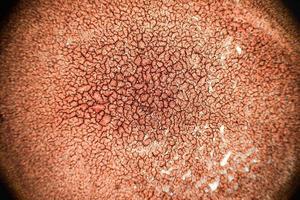 sangue coagulato solidificato visto su una vista al microscopio 100x. lo striscio di sangue al microscopio presenta neutrofili e globuli rossi foto