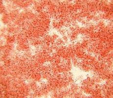 lo striscio di sangue al microscopio presenta neutrofili e globuli rossi. micro sezioni fotografiche ad alto ingrandimento con microscopio ottico foto