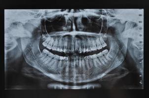 radiografia dei denti di tutto il viso foto