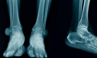 immagine radiografica della caviglia in tonalità blu foto