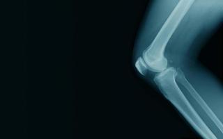 spazio banner immagine a raggi X del ginocchio dell'osteoartrite foto