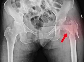radiografia dell'anca che mostra frattura guarita collo femu sinistro.nessuna lussazione, distruzione ossea.spazio articolare normale.nessun versamento articolare. foto
