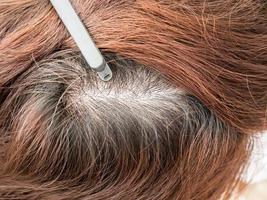 testa di donna con diradamento dei capelli, caduta dei capelli foto