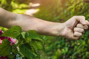 bruciarti le mani con il primo piano delle ortiche foto